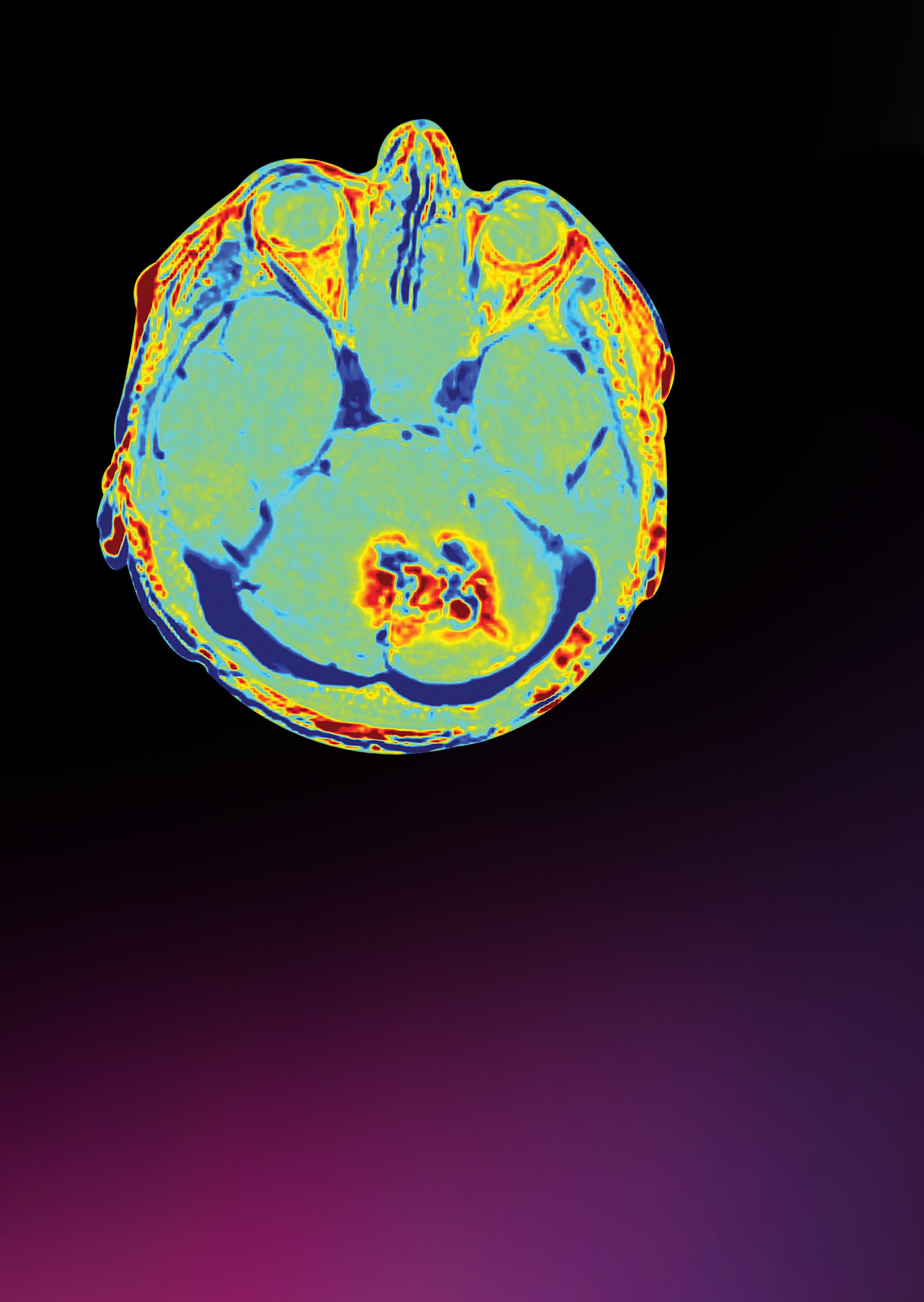 Treat Multiple Brain Metastases with SRS using Elements